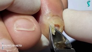 O QUE PODE TER ACONTECIDO  ? #podologomaurelio #ingrowntoenail #nails #like @podologo.maurelio