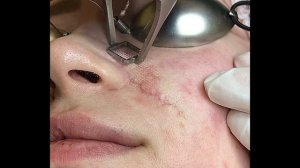 Хирургическая коррекция келоидного рубца, носогубной борозды. Пластика Z- лоскутами по Лимбергу.