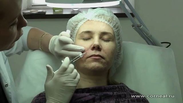 Контурная пластика - делаем носогубку иглой
