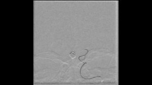 Эмболизация аневризм артерий головного мозга