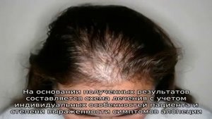 Андрогенная алопеция у женщин