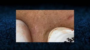 ЖИРНЫЕ ЧЕРНЫЕ ТОЧКИ/ BLACKHEAD Removal.Squeezing acne.