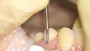 Снятие металлокерамической коронки
