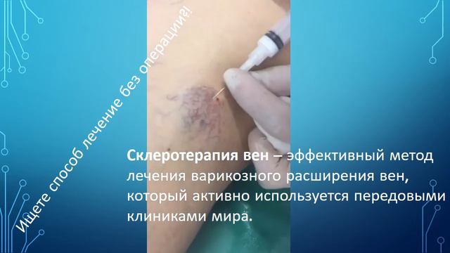 Склеротерапия вен нижних конечностей.