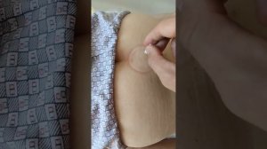 Встаём после инсульта на ноги. Часть 12. 2 и 3 постановка хиджама на ноги и крестец.