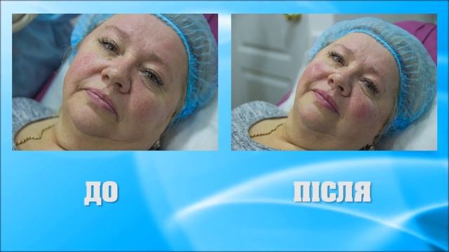 Доктор Радкевич Вікторія - об'ємне моделювання обличчя препарат "Ideal Subskin". смотреть онлайн