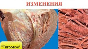 Паренхиматозная жировая дистрофия