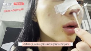 Ринопластика в Корее