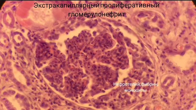 Экстракапиллярный гломерулонефрит смотреть онлайн
