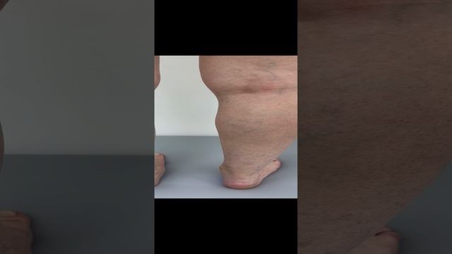 Усиление сосудистой сетки после ЭКО. Флеболог Москва