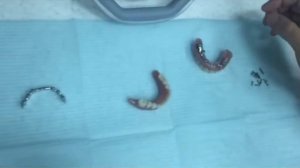 Балочная конструкция на имплантах