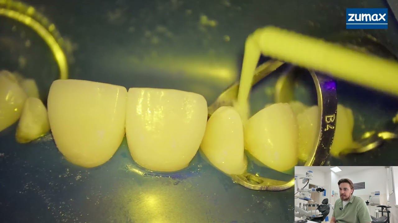 СТОМБУДНИ#37 Адгезивная фиксация виниров и коронки смотреть онлайн