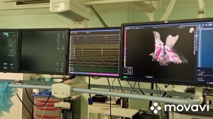 РЧА фибрилляции предсердий, сообщение вены Маршала с левой верхней легочной веной