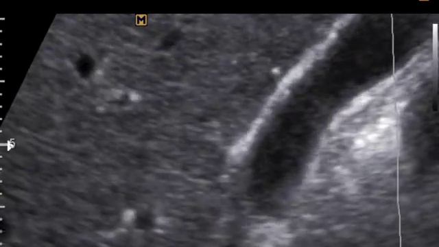 Дивертикул желчного пузыря или кисты? (18-10-17) смотреть онлайн