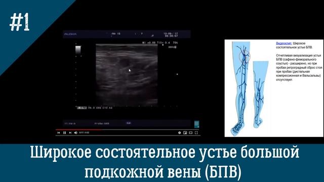 УЗИ вен. Широкое состоятельное устье БПВ.