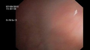 Колоноскопия с биопсией, рак прямой кишки.