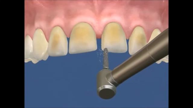 Уроки стоматологии: Как изготавливают виниры в стоматологическом кабинете смотреть онлайн
