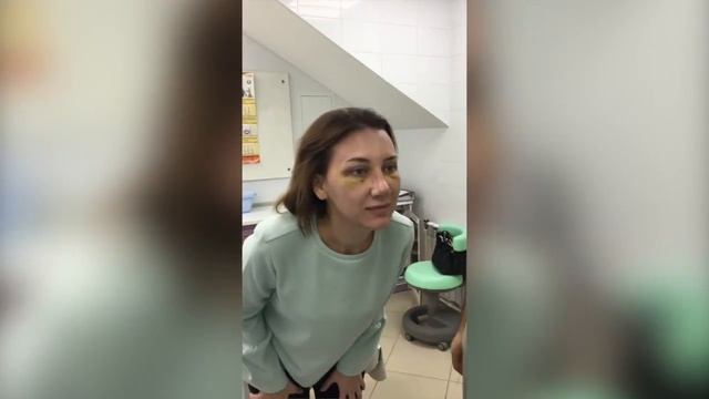 Снятие гипса после ринопластики, снятие стрипов после блефаропалстики, хирург Абрамян С.М.