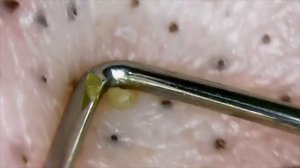 Удаление и выдавливание черных точек и прыщей под расслабляющую музыку