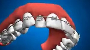 Брекет система avi 360p