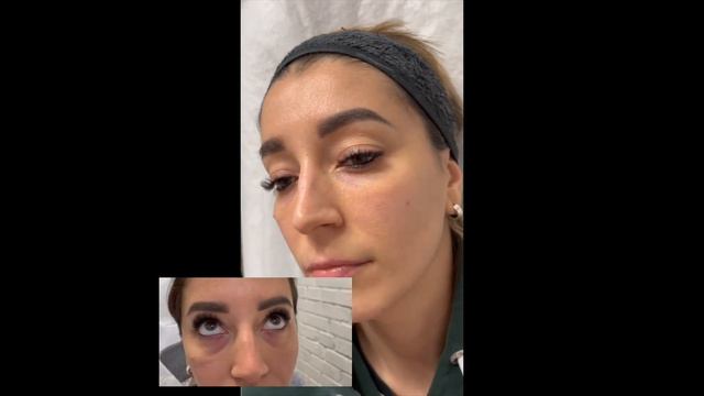 КОРРЕКЦИЯ СЛЁЗНОЙ БОРОЗДЫ 💉Результат через месяц 🪡 dr. Халима смотреть онлайн