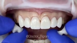 ВИНИРЫ / Примерка полноконтурных виниров цвета bleach 3