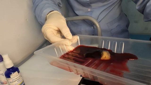Венозное кровопускание ,проверка гематокрита на глаз ,и Холестерина Низкой плотности