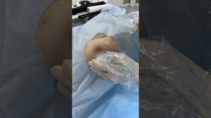 Вакуумное удаление доброкачественных новообразований молочной железы