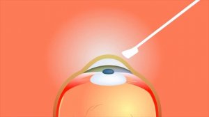 Что, если супер клей попадёт в глаз?