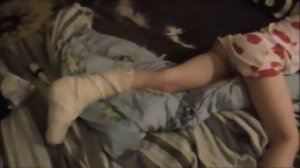 Девочка в гипсе !