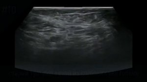 УЗИ сосудов. Старый тромбоз одной из глубоких вен голени