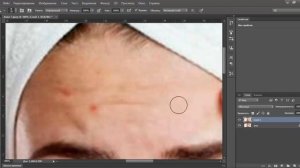 Как избавиться от прыщей