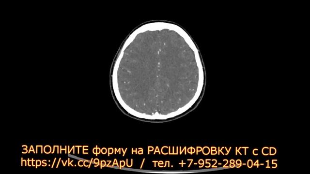 ОПУХОЛЬ В ГАЙМОРОВОЙ ПАЗУХЕ носа на КТ расшифровке придаточных пазух