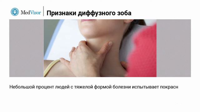 Признаки диффузного токсического зоба смотреть онлайн