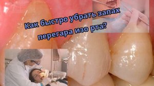 Как быстро убрать запах перегара изо рта?