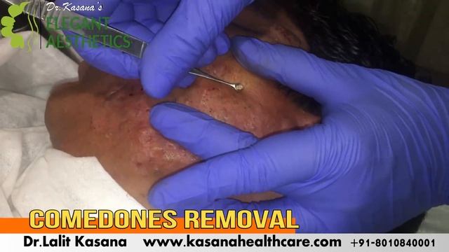 BLACKHEAD REMOVAL FULL VIDEO смотреть онлайн