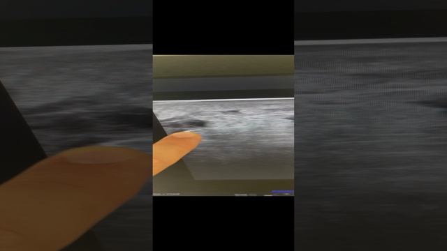 Узи вен. Тромбоз. Варикоз. Отек ноги. Покраснение кожи. Флеболог Москва. Флеболог. Лечение вен смотреть онлайн