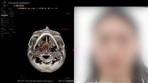 Zygoma reduction didn't help, and I want chin reduction while leaving mandibular angles