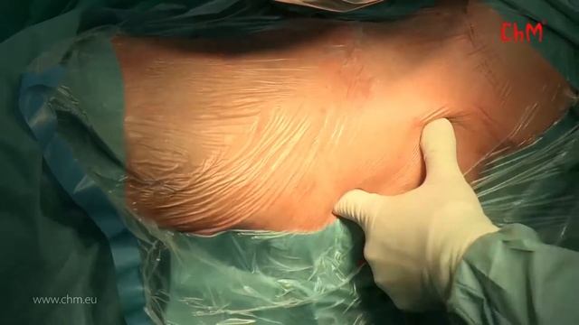 Анатомический бедренный стержень CHARFIX2 смотреть онлайн