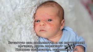 Сепсис новорожденных