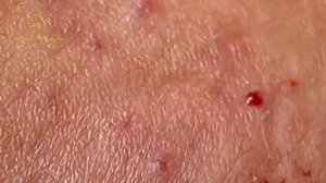 Professional bleckheads   Выдавливание черных точек прыщей   самое залипательное видео 2023