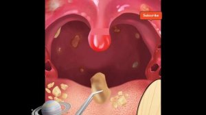 (ASMR) Cause of bad breath tonsil stones removal animation surgery
