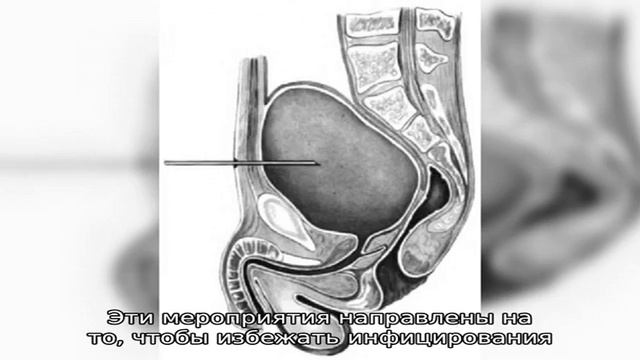 Пункция мочевого пузыря и техника ее выполнения смотреть онлайн