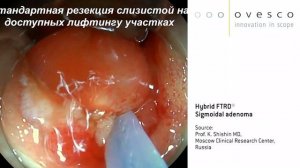 Полностенная резекция толстой кишки при помощи системы FTRD®