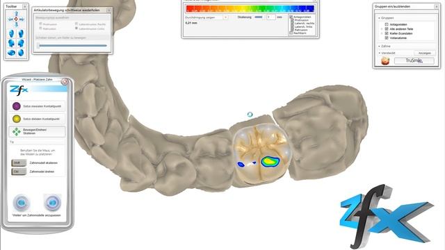 Zfx CAD Software - Virtual Articulator