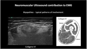 Ультразвуковое исследование мышц (миопатия, болезнь моторного нейрона и прочие)