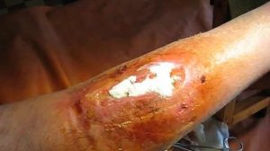 Циркулярная повязка
