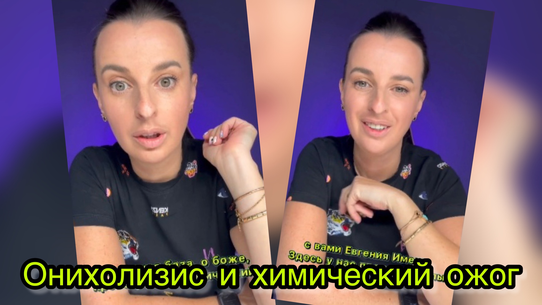 Онихолизис и химический ожог