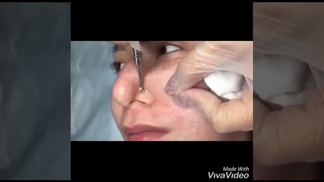 Чистка лица. смотреть онлайн