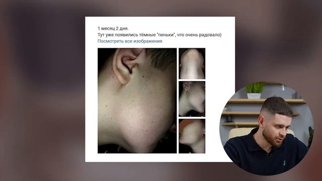 НЕ БЫЛО НИ ВОЛОСИНКИ, НО ЧЕРЕЗ 3 МЕСЯЦА КСИНОКСИН СДЕЛАЛ ЭТО! смотреть онлайн